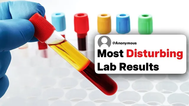 Thumbnail for the UnderSparked video: Doctors & Nurses, What's The Most Disturbing Lab Result You've Seen In A Patient?